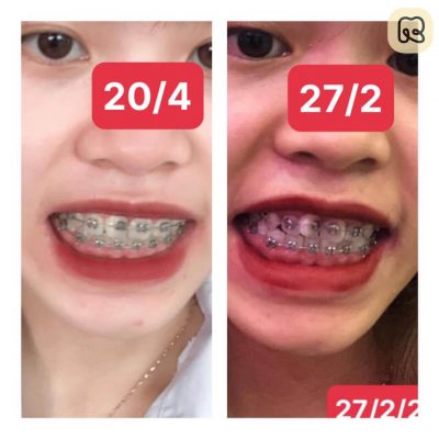 Tổng hợp hình ảnh thay đổi trước và sau khi niềng răng tại Ruby Dental 16
