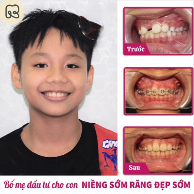 Tổng hợp hình ảnh thay đổi trước và sau khi niềng răng tại Ruby Dental 15