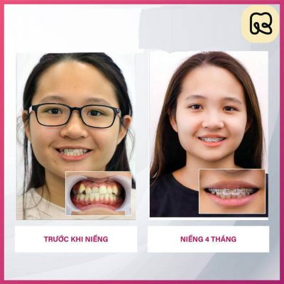 Tổng hợp hình ảnh thay đổi trước và sau khi niềng răng tại Ruby Dental 17