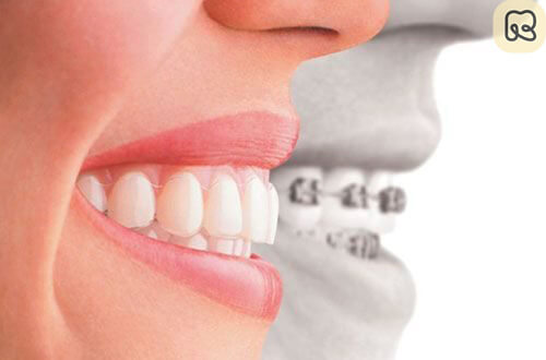 Niềng răng mắc cài kim loại là gì? Giá bao nhiêu 2023 12