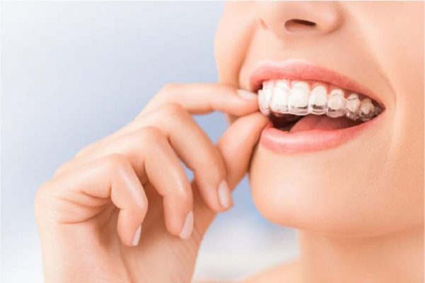 Những tác dụng của niềng răng mang lại cho bạn 18
