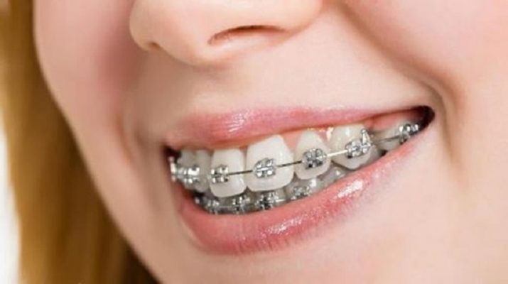 Niềng răng mắc cài kim loại là gì? Giá bao nhiêu 2023 6