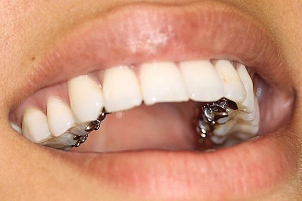 Niềng răng là gì? Phương pháp kiến tạo nên nụ cười rạng rỡ 9