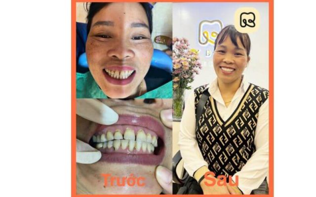 Bọc răng sứ tại Thái Bình đẹp cho nụ cười hoàn hảo 6