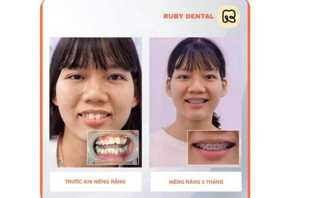 khách hàng niềng răng tại Nha khoa Quốc Tế Ruby Dental 2