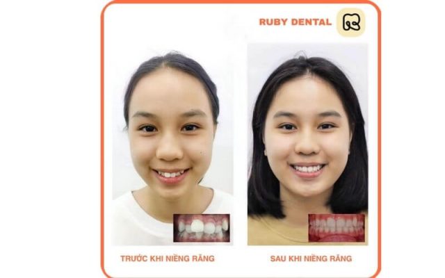 khách hàng bọc răng sứ tại Nha khoa Quốc Tế Ruby Dental