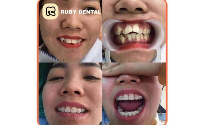 khách hàng tại niềng răng khấp khểnh Nha khoa Quốc Tế Ruby Dental