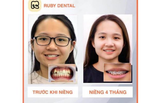 khách hàng niềng răng tại Nha khoa Quốc Tế Ruby Dental 3