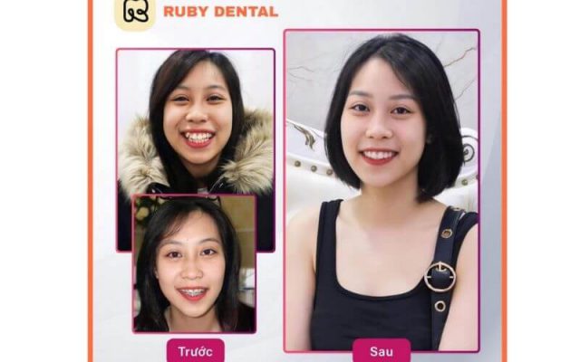khách hàng làm răng sứ thẩm mỹ tại Nha khoa Quốc Tế Ruby Dental