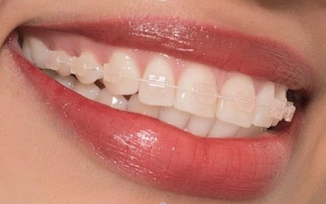 Giá niềng răng 1 hàm giá bao nhiêu tiền? 25