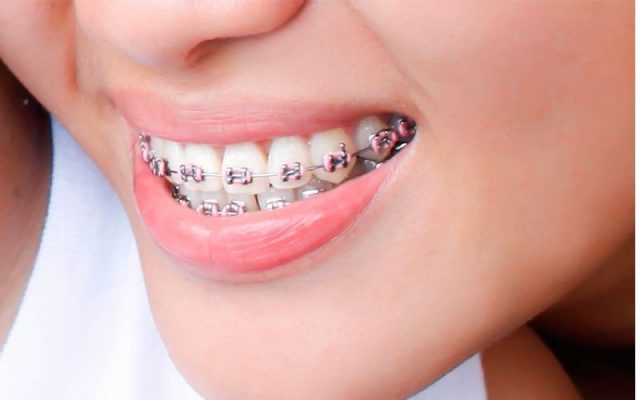 Niềng răng là gì? Phương pháp kiến tạo nên nụ cười rạng rỡ 7