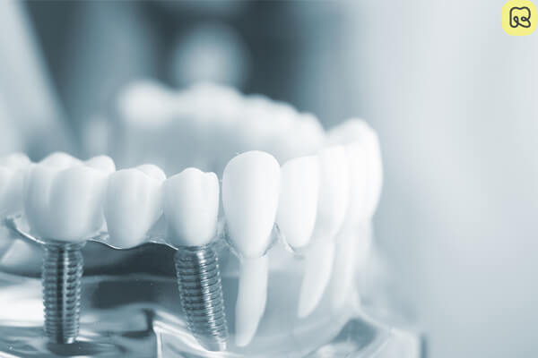 Trồng răng implant là gì? Giá bao nhiêu tiền? Ở đâu tốt 11