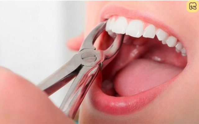 Khi nào nên nhổ răng hàm? 12