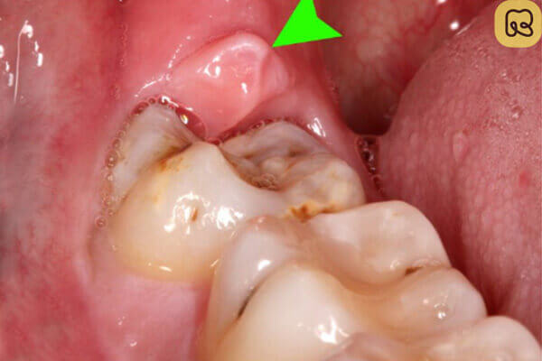 Khi nào nên nhổ răng hàm? 15