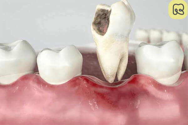 Khi nào nên nhổ răng hàm? 13