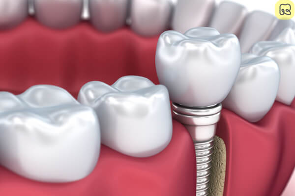 Trồng răng implant là gì? Giá bao nhiêu tiền? Ở đâu tốt 12