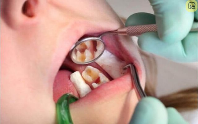 Chữa Tủy Răng Và Những Điều Cần Biết 8