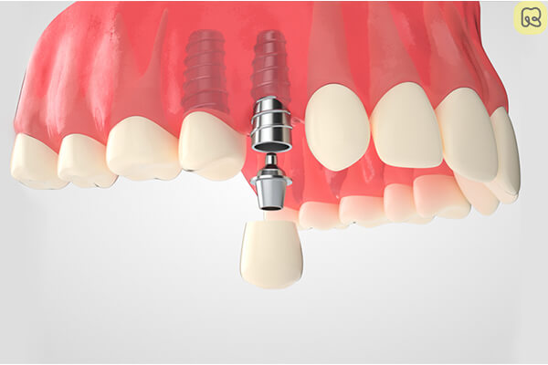 Trồng răng implant là gì? Giá bao nhiêu tiền? Ở đâu tốt 13