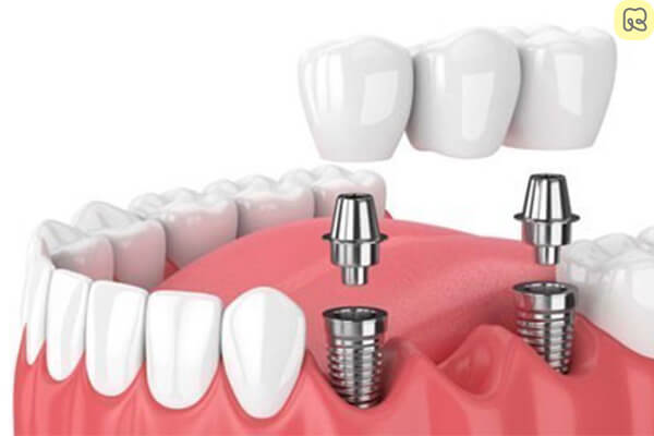 Trồng răng implant là gì? Giá bao nhiêu tiền? Ở đâu tốt 18
