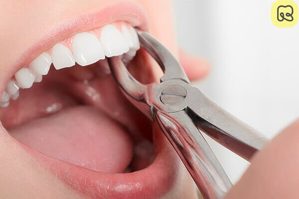 Nhổ răng cấm có nguy hiểm không? 6