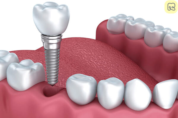 Trồng răng implant là gì? Giá bao nhiêu tiền? Ở đâu tốt 17