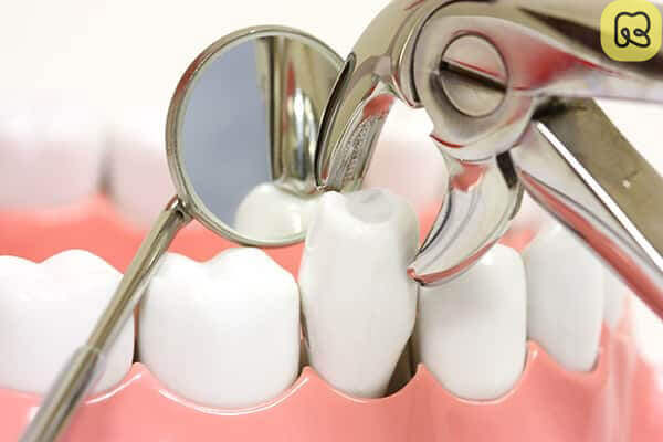 Nhổ răng cấm có nguy hiểm không? 9