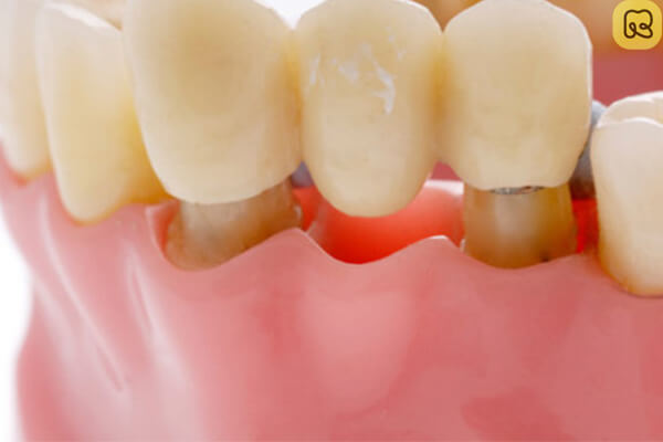 Làm cầu răng sứ có tốt không? Bền không theo chuyên gia 14