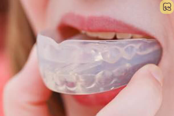 Niềng răng trainer mang lại hiệu quả như thế nào? 12