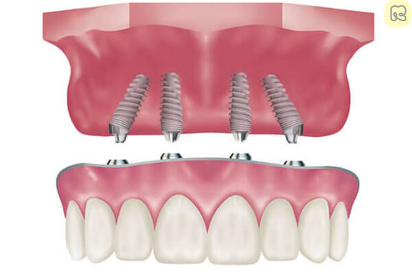 All On 4 Implants- Giải Pháp Cho Người Mất Răng Toàn Hàm 14