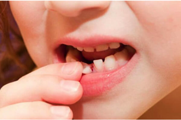 5 Bước Nhổ Răng Sâu Và Các Phương Pháp Nhổ Răng Không Đau 12