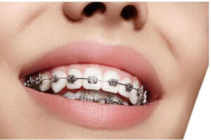 Chi phí niềng răng cho người lớn bao nhiêu? Những yếu tố ảnh hưởng đến giá niềng răng 1