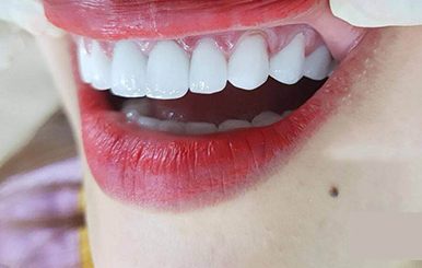 Bọc răng sứ phương pháp chữa răng hô vẩu nhẹ 