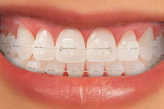 Chi phí niềng răng cho người lớn bao nhiêu? Những yếu tố ảnh hưởng đến giá niềng răng 1
