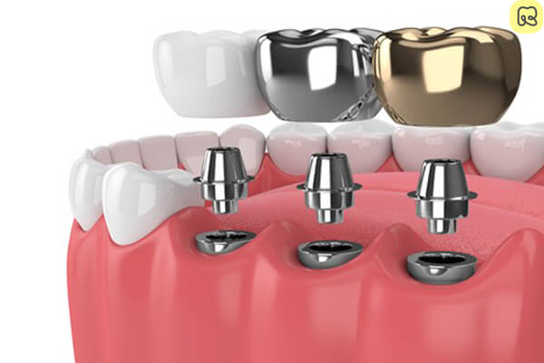 Làm răng giả cố định bằng phương pháp cấy ghép implant