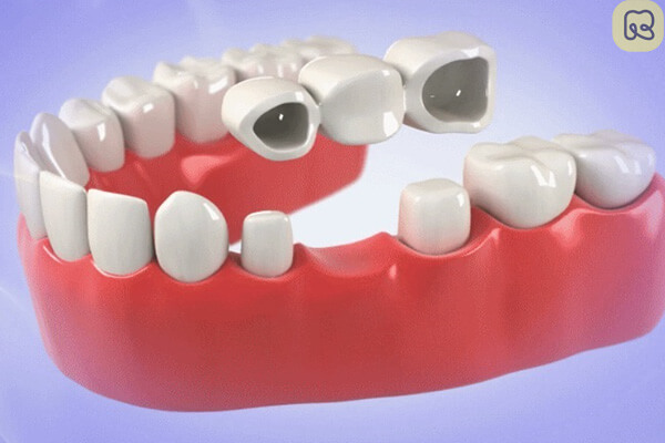 Lưu ý gì khi trồng răng giả cố định để đảm bảo kết quả tốt nhất?