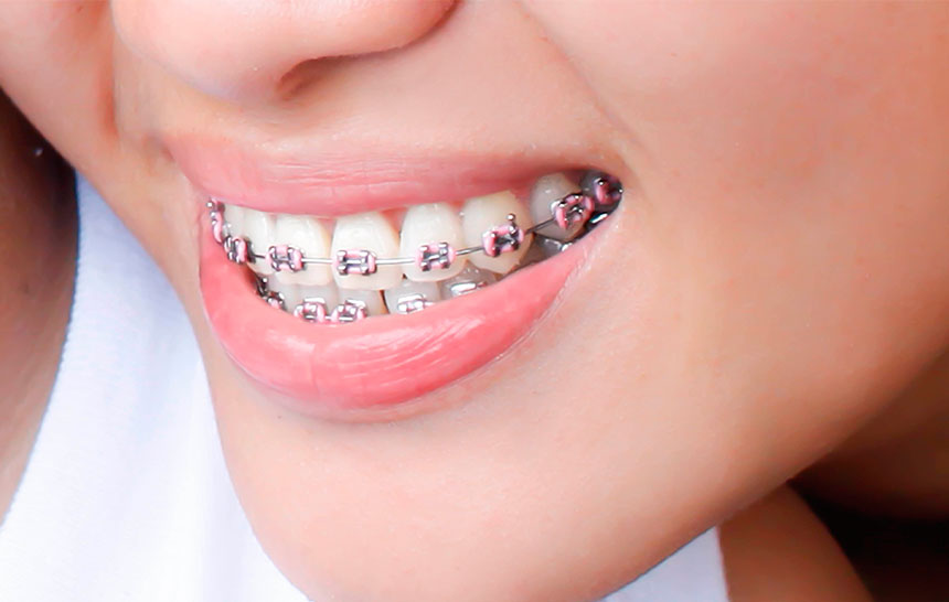Độ tuổi niềng răng thích hợp nhất là bao nhiêu và dựa trên những tiêu chí nào