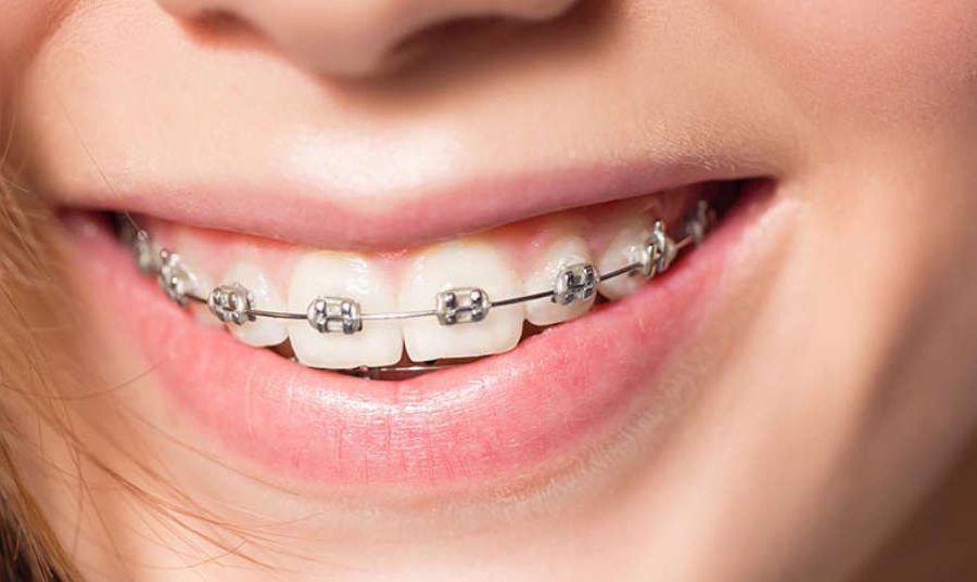 Độ tuổi niềng răng là gì và tại sao lại quan trọng?