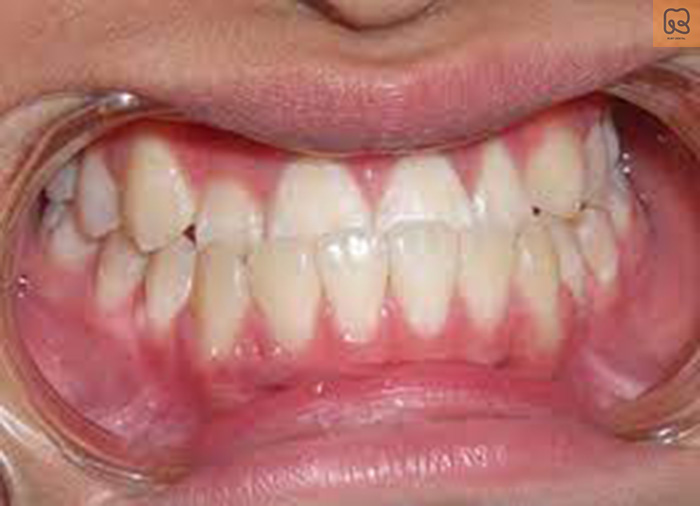 Lưu ý gì khi điều trị móm răng để đảm bảo kết quả tốt nhất?