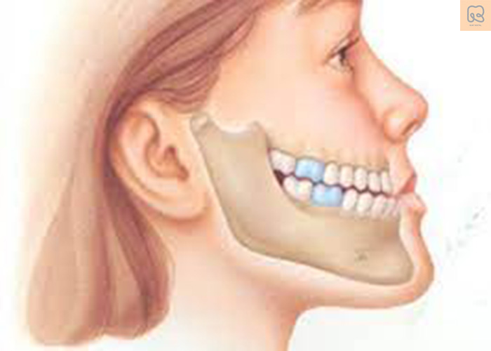 Cách điều trị móm răng hiệu quả là gì?