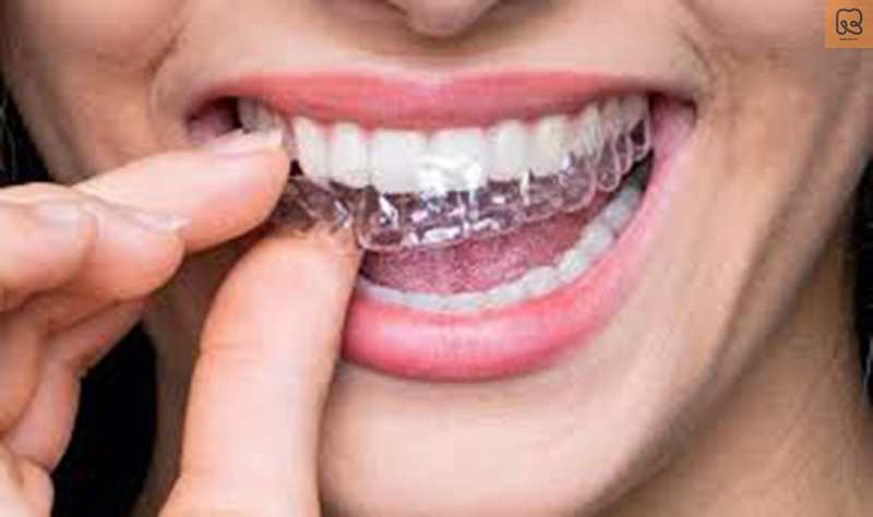 Niềng răng trả góp: Giải pháp tiết kiệm và hiệu quả cho nụ cười hoàn hảo 2