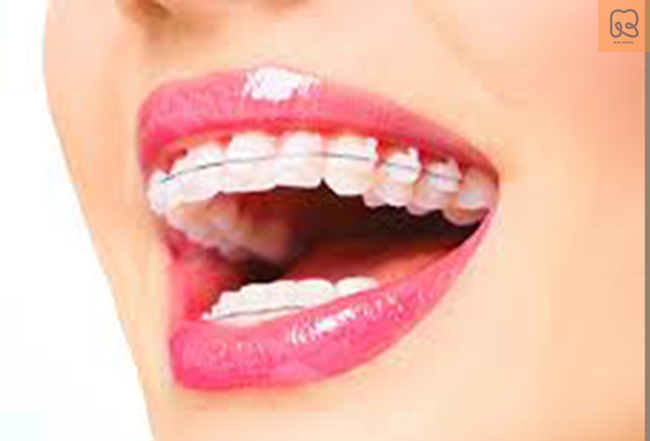 Niềng răng trả góp: Giải pháp tiết kiệm và hiệu quả cho nụ cười hoàn hảo 3
