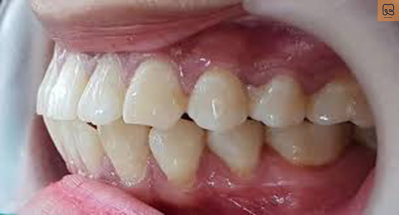 Răng hô vẩu là gì?
