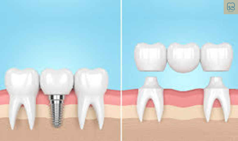 lắp răng hàm giả cố định mang lại nhiều lợi ích