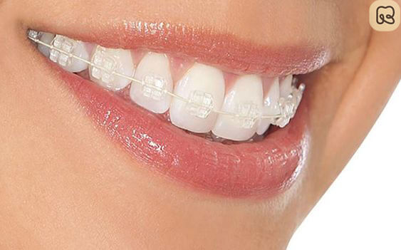 Niềng răng trả góp: Giải pháp tiết kiệm và hiệu quả cho nụ cười hoàn hảo 5