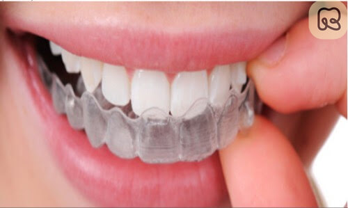 Niềng răng trả góp: Giải pháp tiết kiệm và hiệu quả cho nụ cười hoàn hảo 4