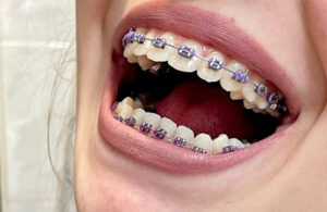 Quy Trình Niềng Răng Tại Ruby Dental 12