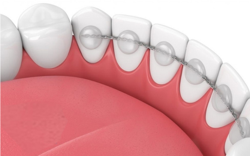 Tháo niềng răng có chạy lại không? Cách ngăn ngừa và khắc phục hiệu quả 6