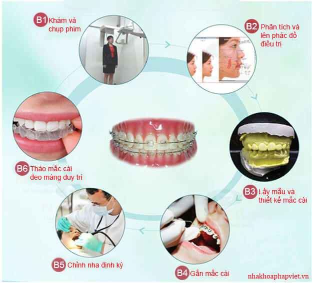 Quy trình niềng răng Ruby Dental 