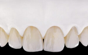 Răng sứ zirconia giá bao nhiêu? Bí quyết có hàm răng đẹp 4