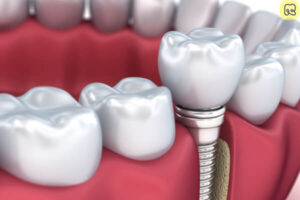 Trồng răng implant là gì? Giá bao nhiêu tiền? Ở đâu tốt 7
